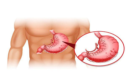 Các Kiến Thức Cơ Bản Về Bệnh Sa Dạ Dày