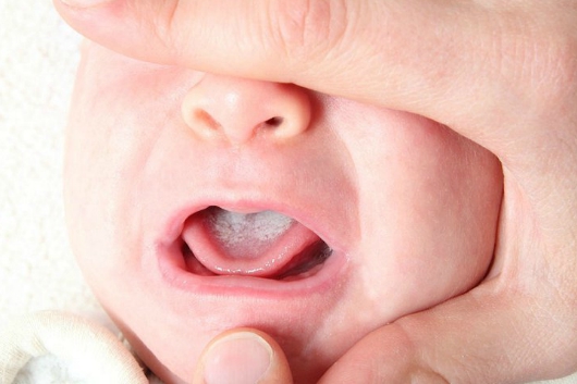 Cách Phòng Và Điều Trị Bệnh Nấm Lưỡi Ở Trẻ Nhỏ