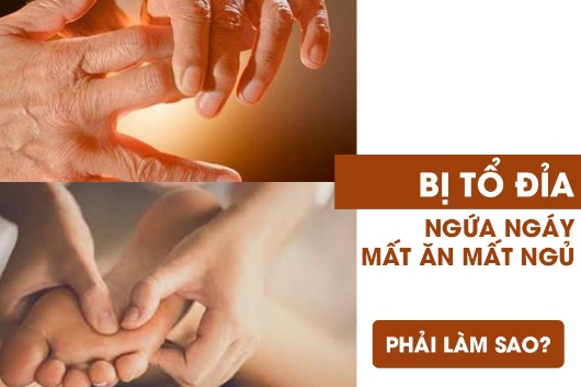 7 Cách Chữa Bệnh Tổ Đỉa Tại Nhà Hiệu Quả Nhanh