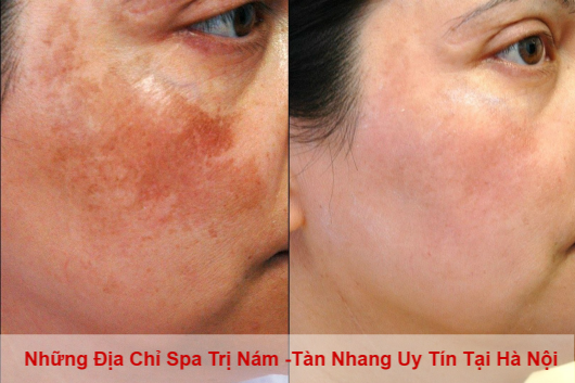 Những Spa Có Thương Hiệu Trị Nám Tàn Nhang Uy Tín Tại Hà Nội