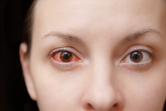 Cách Phòng Ngừa Và Điều Trị Bệnh Viêm Kết Mạc Mắt