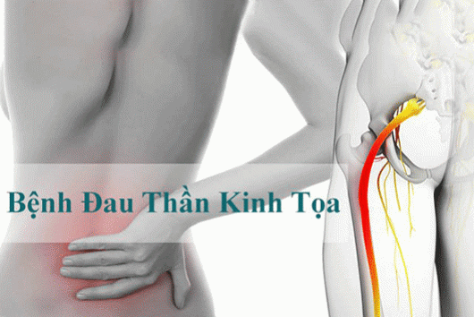 Bài tập Yoga tốt cho người bị bệnh đau thần kinh tọa