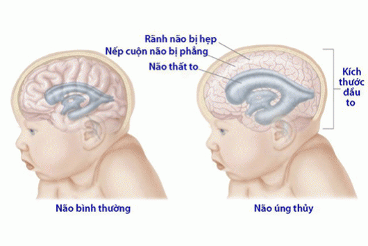 Bệnh Não Úng Thủy Có Vắc Xin Ngừa Không.? Có Gây Nguy Hiểm Cho Trẻ Nhỏ