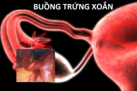 xoan-buong-trung-va-cac-phuong-phap-dieu-tri-hien-nay