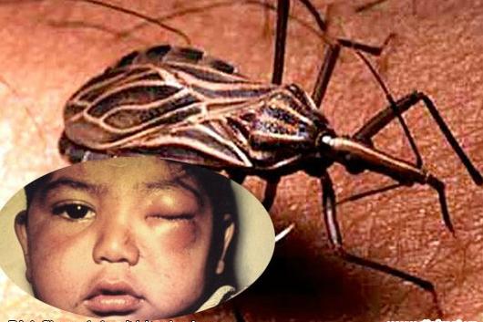 Bệnh Chagas Và Phương Pháp Điều Trị Bệnh Hiệu Quả Nhất